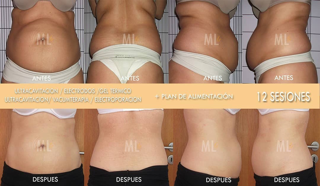Abdomen antes y después de 12 sesiones de tratamiento reductor combinado, en cuatro vistas